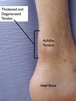 Achilles Tendonitis Coral Gables Foot Care Miami